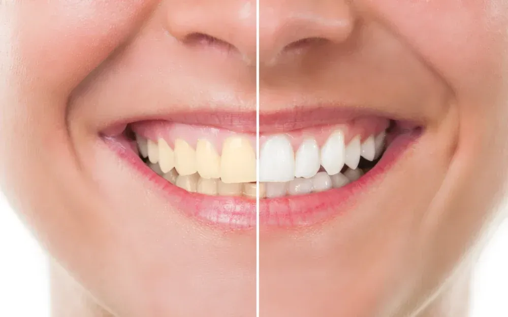 Before and after professional teeth whitening results showing a brighter smile